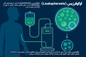 لوکوفرزیس روشی است برای جدا کردن و خارج کردن گلبولهای سفید (لوکوسیتها) از خون بیمار یا اهداکننده.